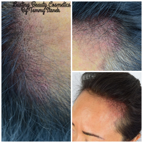 Ladies Hairline Pigmentation